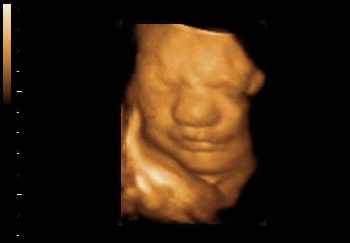3D ultrasound image at 32 weeks